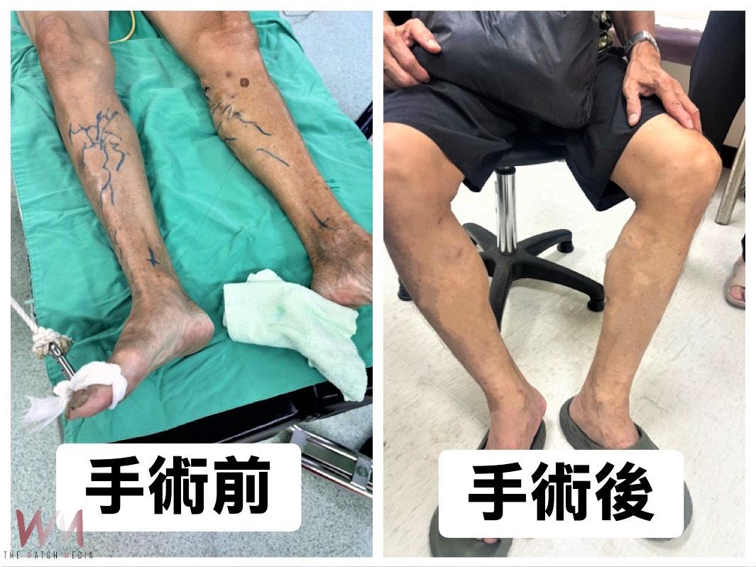 久站易患靜脈曲張 雷射手術治療無明顯傷口及疼痛感 - https://www.watchmedia01.com